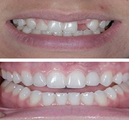 Dental Implants Smiles 1