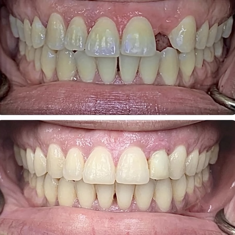 Dental Implants Smiles 2