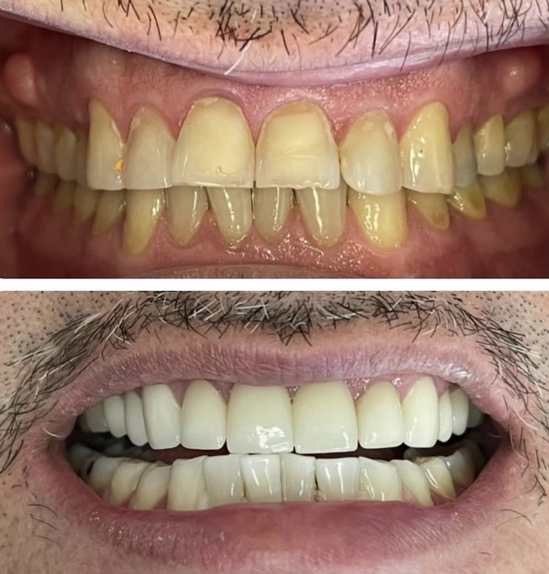 Dental Veneers Smiles 1