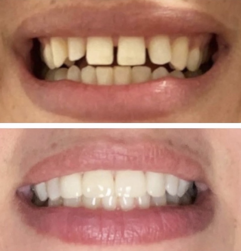 Dental Veneers Smiles 2
