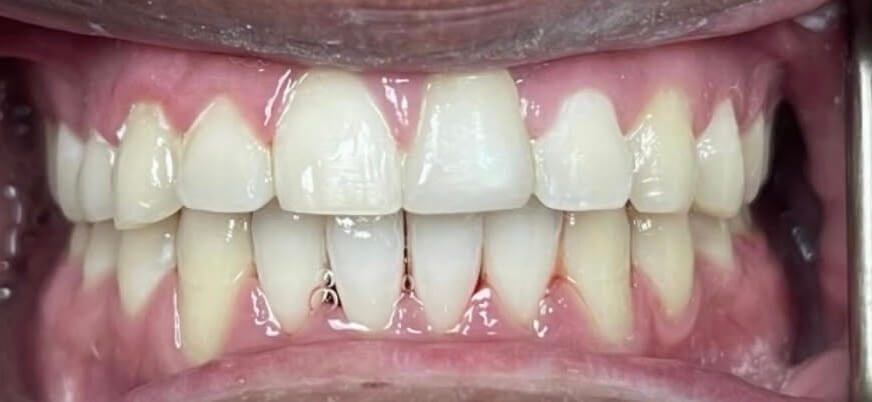 Smile Design 1 After