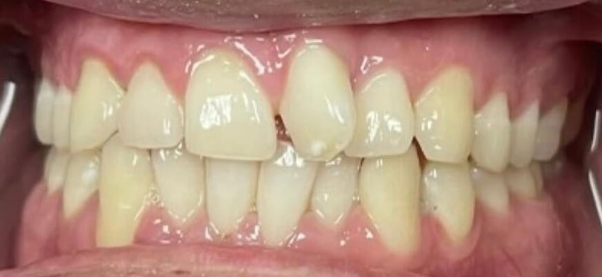 Smile Design 1 Before