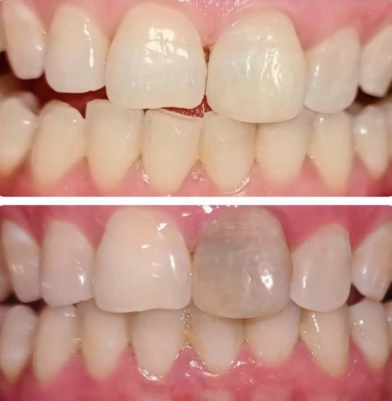 Teeth Whitening Smiles 1