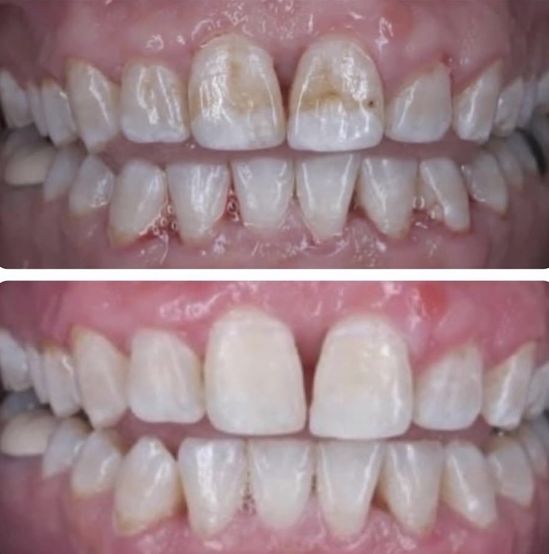 Teeth Whitening Smiles 2