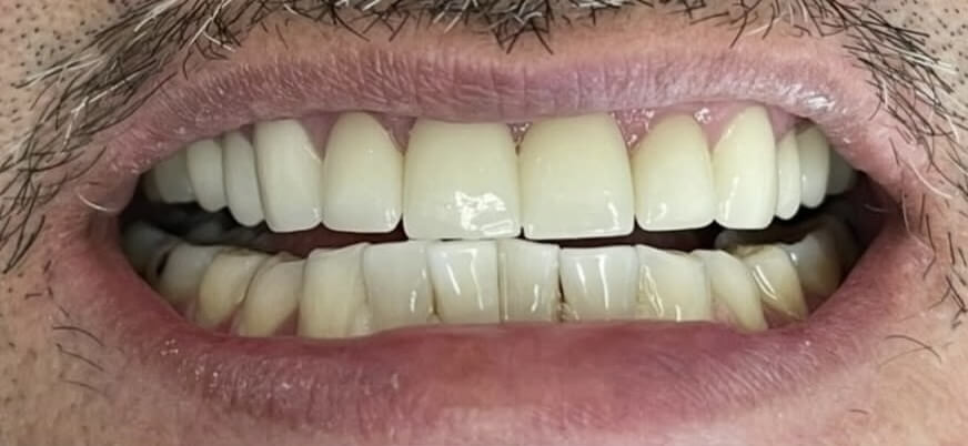 Dental Veneers 1 After