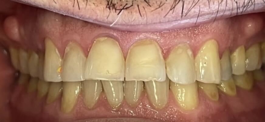 Dental Veneers 1 Before